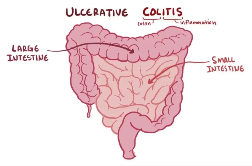 Understanding Ulcerative Colitis: Symptoms, Treatments, and Diet